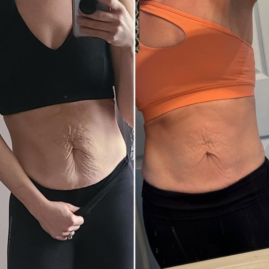 SeekGlo deep healing stretch mark treatment